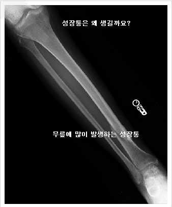 [김현일 원장의 한방칼럼]성장통이란?