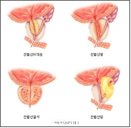 슬픈 남성의 암 ‘전립선암’ [건강상식] 한국건강관리협..