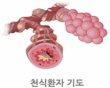 잦은 기침, 천식? 원인과 증상 [건강상식] 한국건강관..